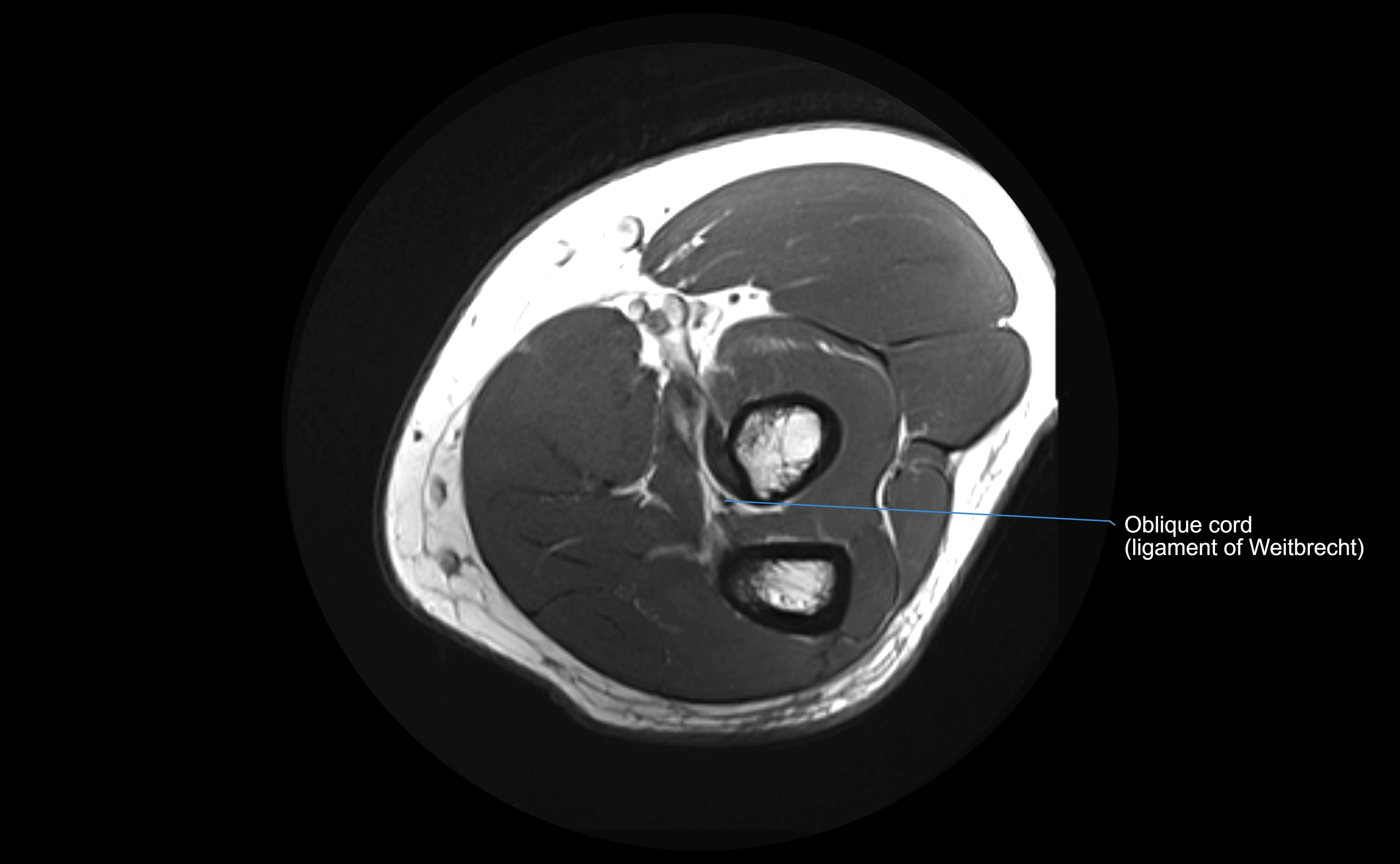 MRI elbow ligaments axial cross sectional anatomy 3T  radiology  image-img-00001-00024.webp
